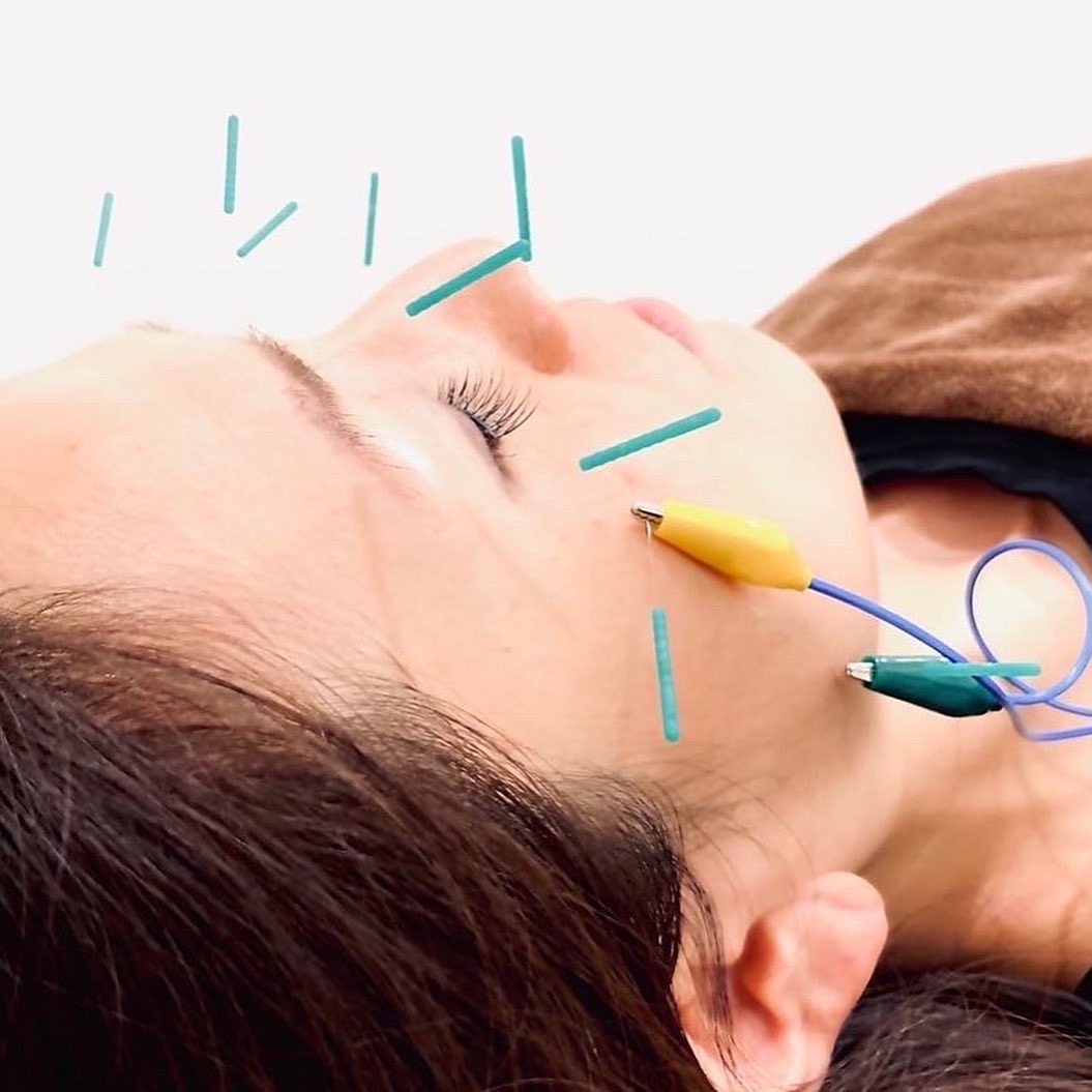 美容鍼