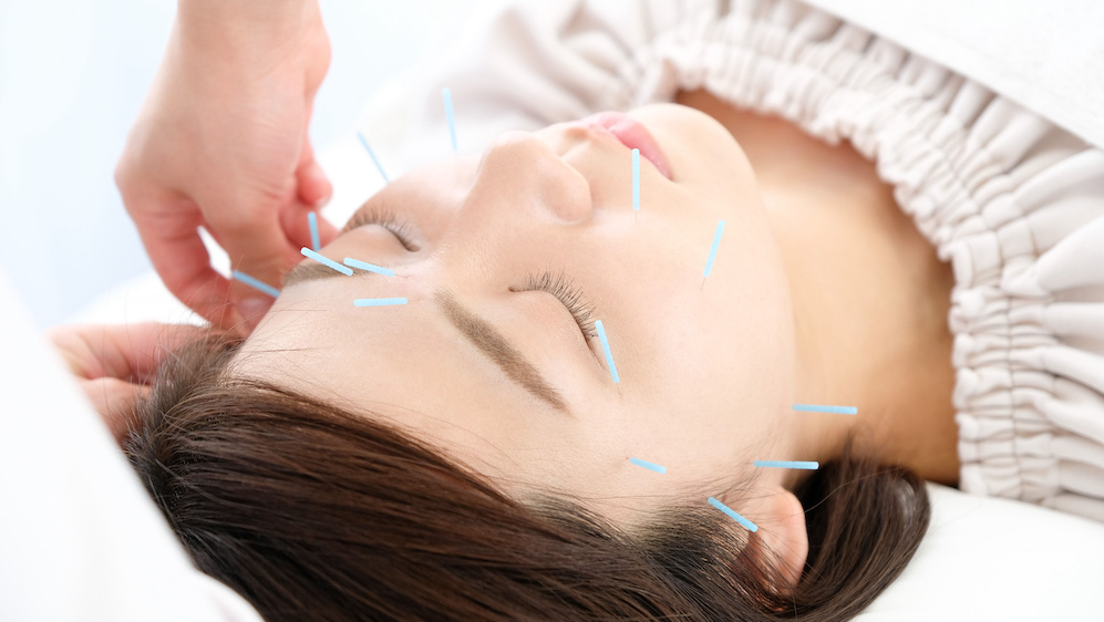 美容鍼とは?